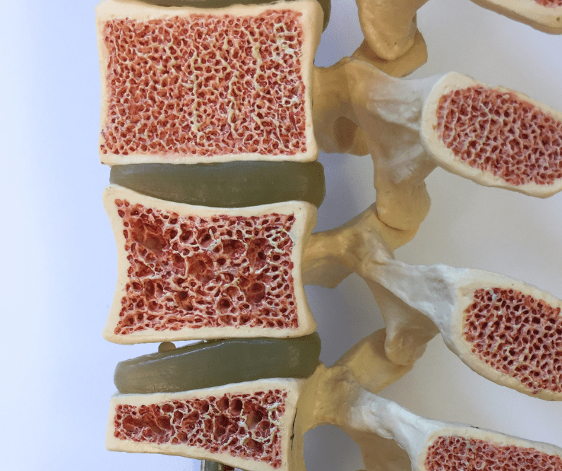 Osteoporose