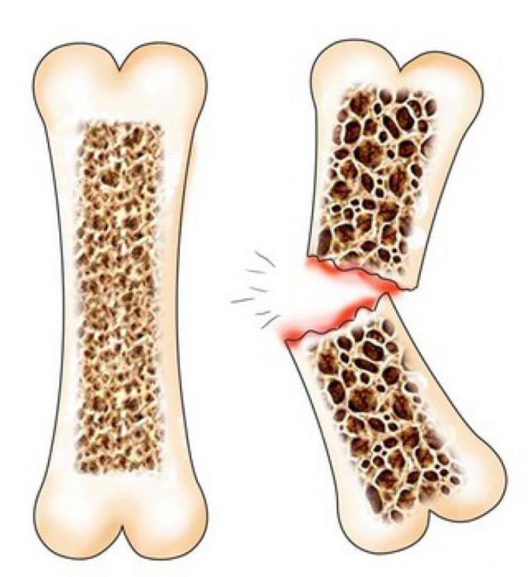osteoporose